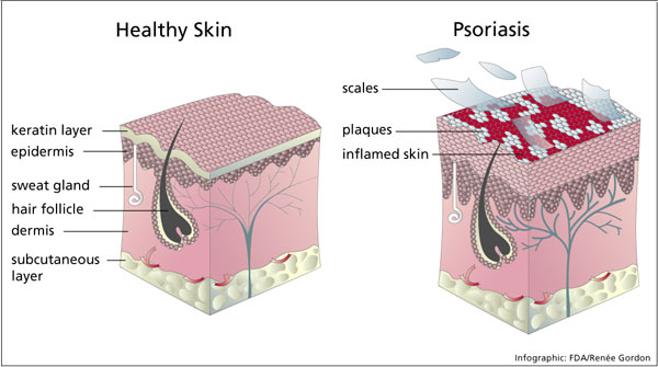 psoriasisinfo